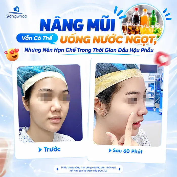 Nâng Mũi Uống Nước Ngọt Được Không? Những Lưu Ý Sau Phẫu Thuật