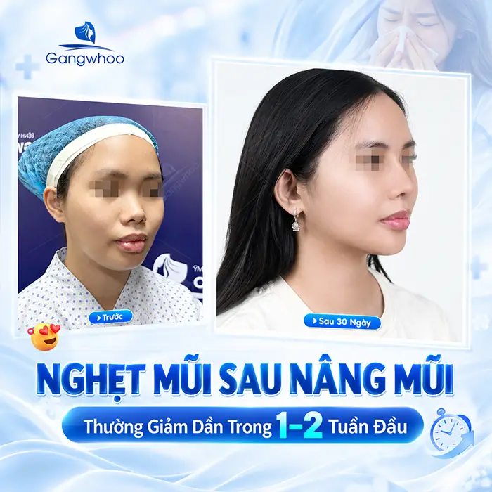 Nghẹt Mũi Sau Khi Nâng Mũi Có Sao Không? Khi Nào Cần Đi Kiểm Tra?