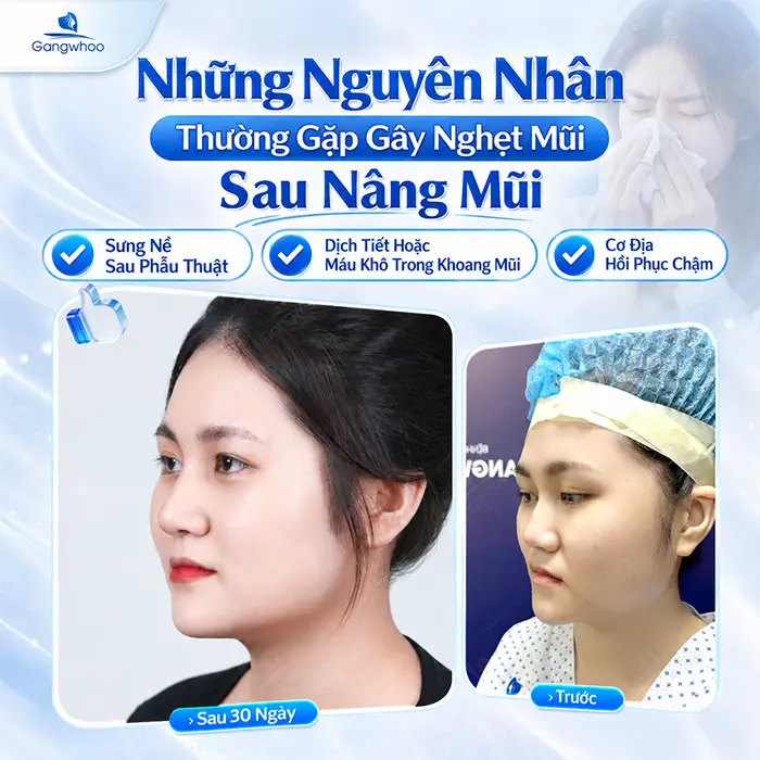Nghẹt Mũi Sau Khi Nâng Mũi Có Sao Không? Khi Nào Cần Đi Kiểm Tra?