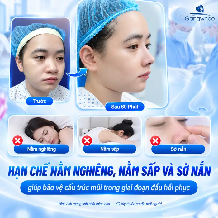 Những Hiện Tượng Sau Khi Nâng Mũi Thường Gặp Và Dấu Hiệu Cần Lưu Ý
