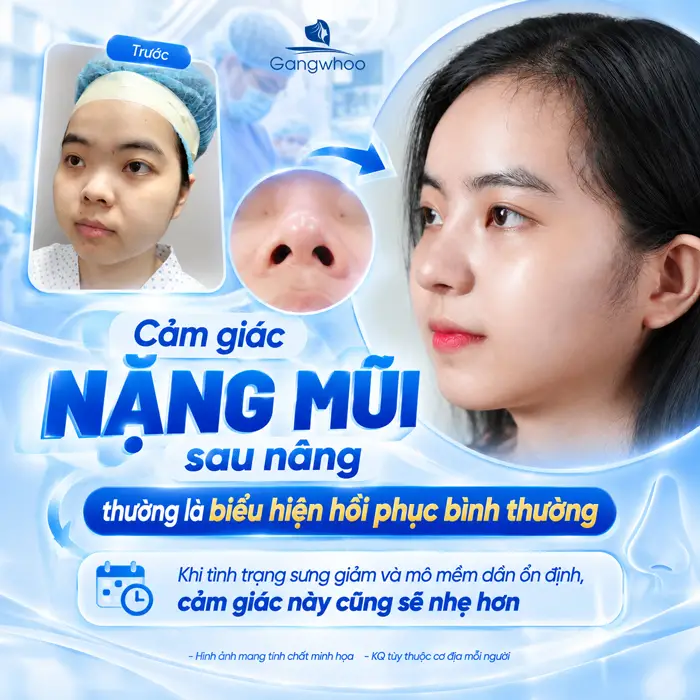 Những Hiện Tượng Sau Khi Nâng Mũi Thường Gặp Và Dấu Hiệu Cần Lưu Ý