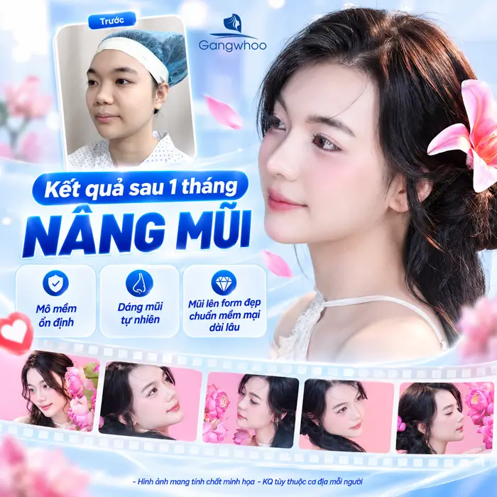 Những Hiện Tượng Sau Khi Nâng Mũi Thường Gặp Và Dấu Hiệu Cần Lưu Ý