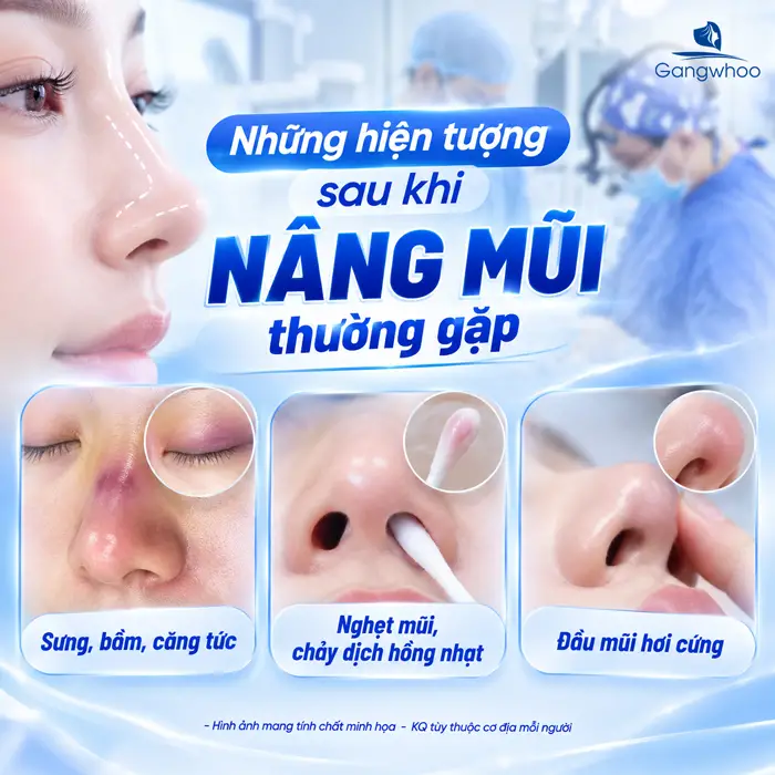Những Hiện Tượng Sau Khi Nâng Mũi Thường Gặp Và Dấu Hiệu Cần Lưu Ý