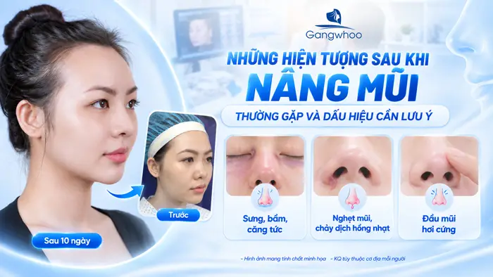 Những Hiện Tượng Sau Khi Nâng Mũi Thường Gặp Và Dấu Hiệu Cần Lưu Ý