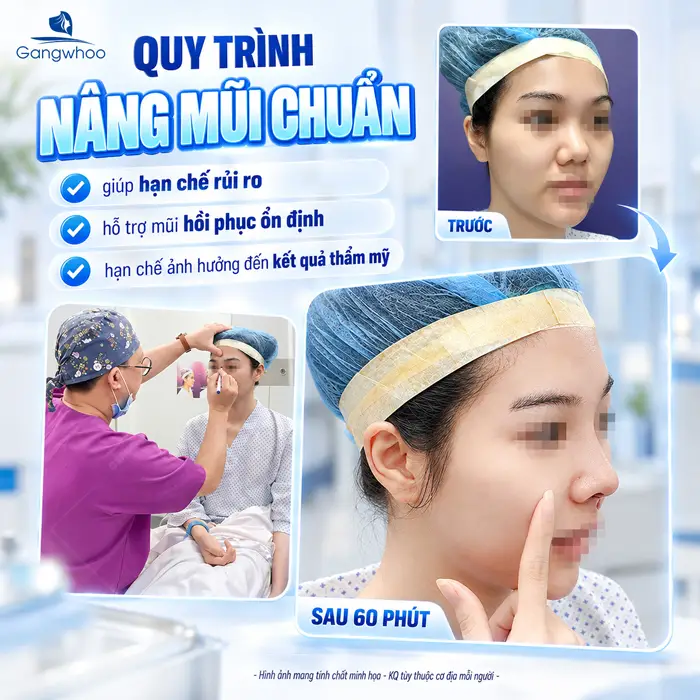 Quy Trình Nâng Mũi Gồm Những Bước Nào? Quá Trình Nâng Mũi Diễn Ra Ra Sao?