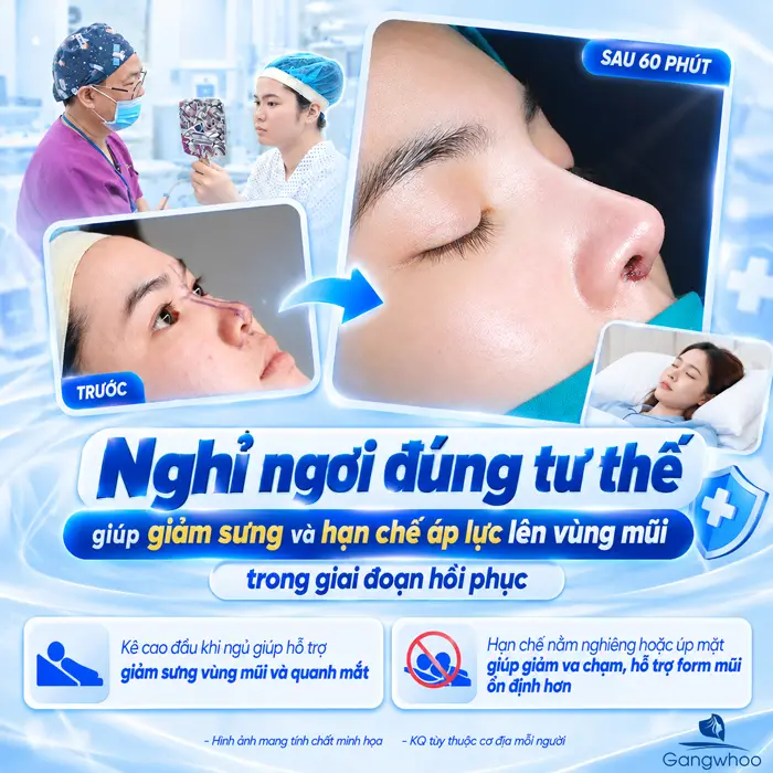 Sau Khi Nâng Mũi Nên Nằm Hay Ngồi? Tư Thế Nghỉ Ngơi Giúp Mũi Hồi Phục Ổn Định