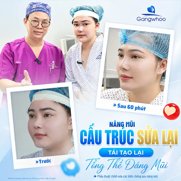 Sửa Lại Mũi Đã Nâng Có Đau Không? Khi Nào Cần Nâng Mũi Sửa Lại?