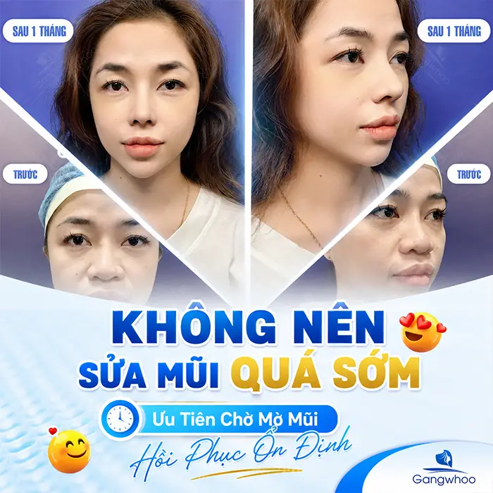 Sửa Lại Mũi Đã Nâng Có Đau Không? Khi Nào Cần Nâng Mũi Sửa Lại?