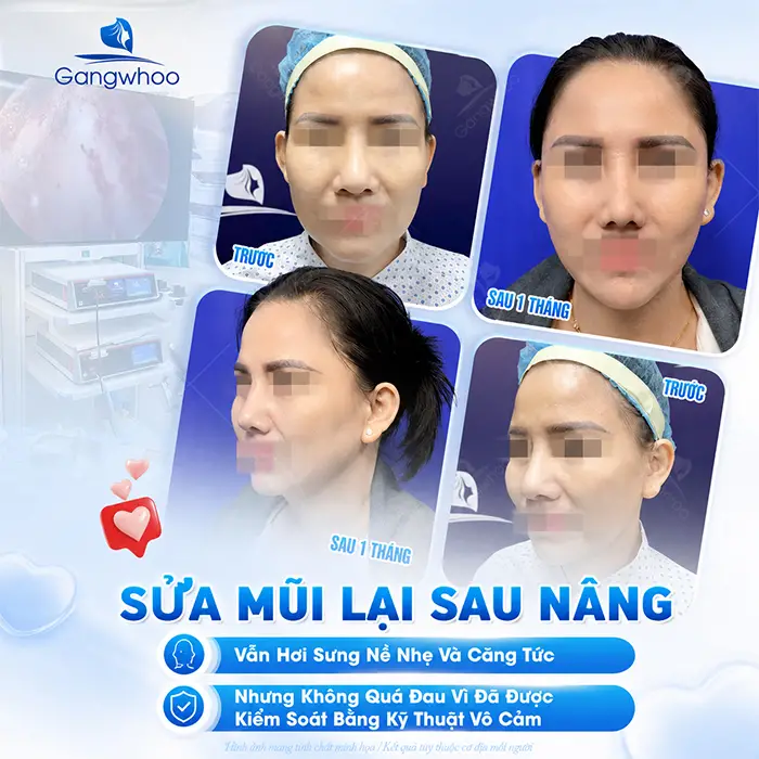 Sửa Lại Mũi Đã Nâng Có Đau Không? Khi Nào Cần Nâng Mũi Sửa Lại?