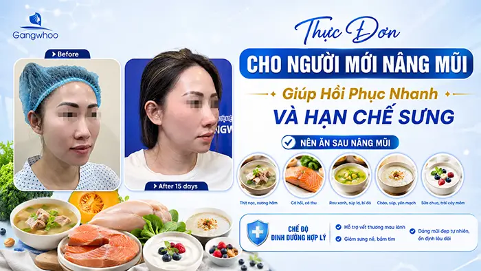 Thực Đơn Cho Người Mới Nâng Mũi Giúp Hồi Phục Nhanh Và Hạn Chế Sưng