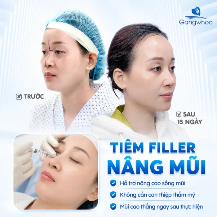 Tiêm Filler Nâng Mũi Có An Toàn Không? Những Điều Cần Biết Trước Khi Thực Hiện