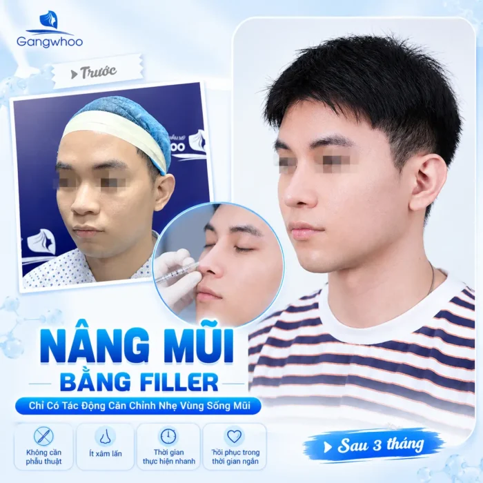Tiêm Filler Nâng Mũi Có An Toàn Không? Những Điều Cần Biết Trước Khi Thực Hiện