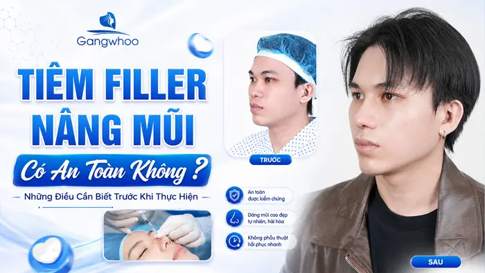 Tiêm Filler Nâng Mũi Có An Toàn Không? Những Điều Cần Biết Trước Khi Thực Hiện