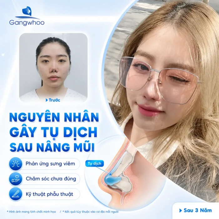 Tụ Dịch Sau Nâng Mũi Có Nguy Hiểm Không? Cách Nhận Biết Và Xử Lý