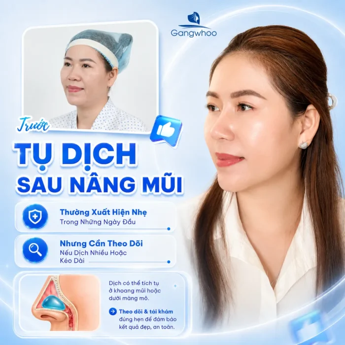 Tụ Dịch Sau Nâng Mũi Có Nguy Hiểm Không? Cách Nhận Biết Và Xử Lý