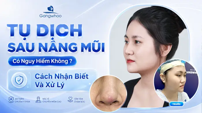 Tụ Dịch Sau Nâng Mũi Có Nguy Hiểm Không? Cách Nhận Biết Và Xử Lý