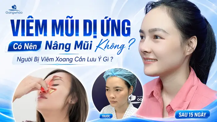Viêm Mũi Dị Ứng Có Nên Nâng Mũi Không? Người Bị Viêm Xoang Cần Lưu Ý Gì?