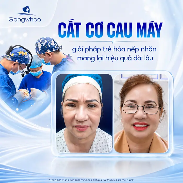 Cắt Cơ Cau Mày Giá Bao Nhiêu? Bảng Giá Năm 2026