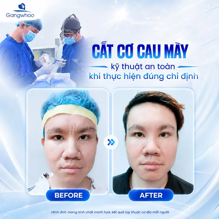 Cắt Cơ Cau Mày Giá Bao Nhiêu? Bảng Giá Năm 2026