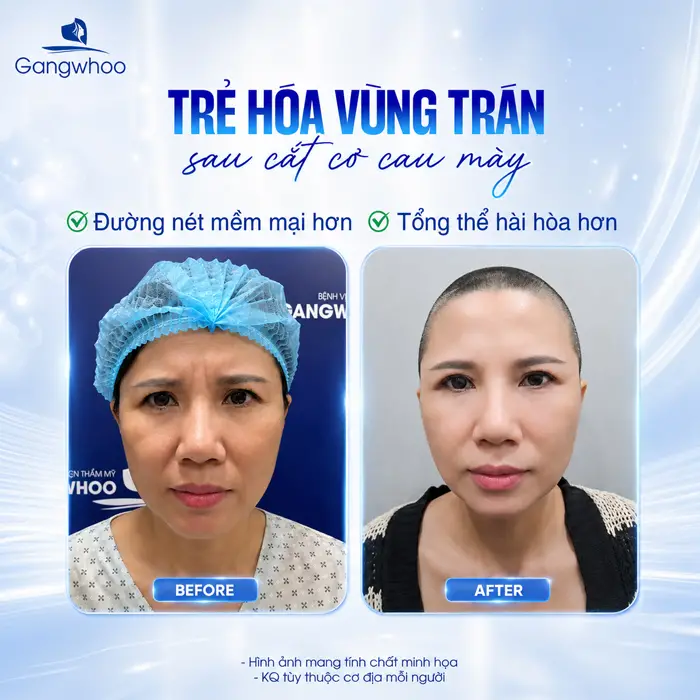 Cắt Cơ Cau Mày Giá Bao Nhiêu? Bảng Giá Năm 2026