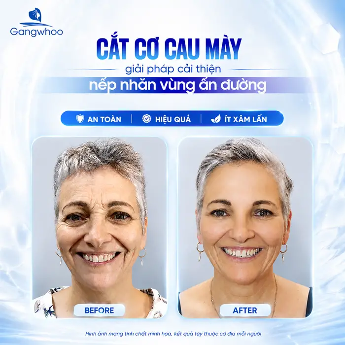 Cắt Cơ Cau Mày Giá Bao Nhiêu? Bảng Giá Năm 2026