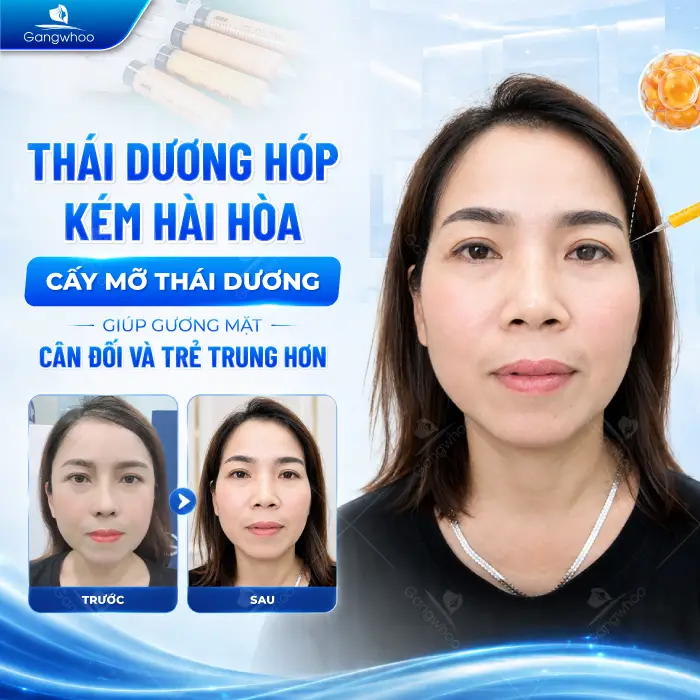 Cấy Mỡ Thái Dương Là Gì? Có An Toàn Không?