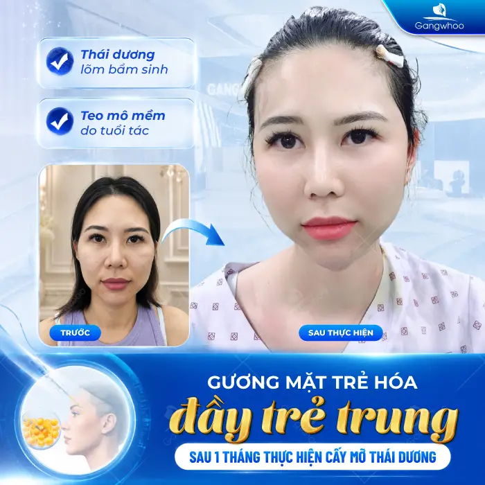 Cấy Mỡ Thái Dương Là Gì? Có An Toàn Không?