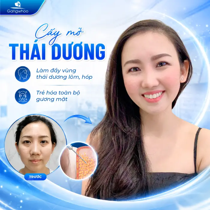 Cấy Mỡ Thái Dương Là Gì? Có An Toàn Không?