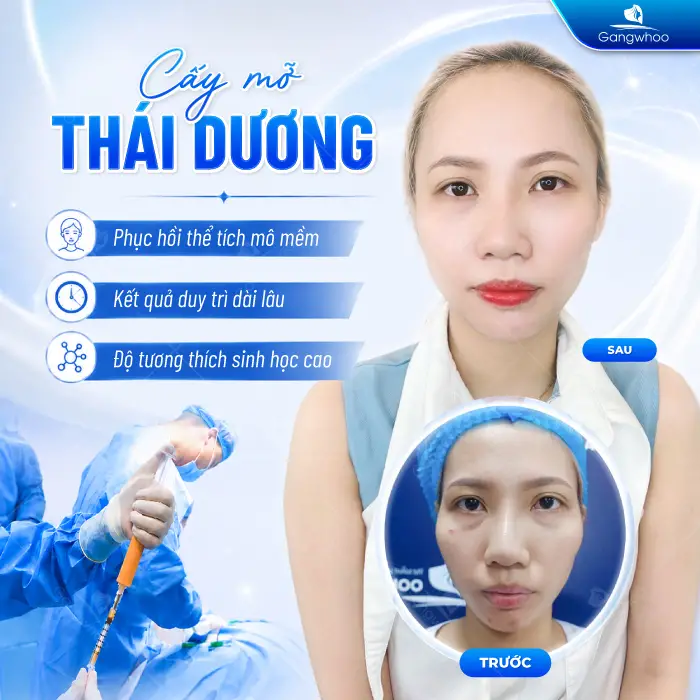 Cấy Mỡ Thái Dương Là Gì? Có An Toàn Không?