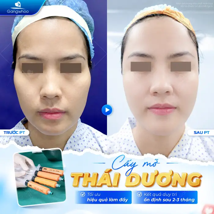 Cấy Mỡ Thái Dương Là Gì? Có An Toàn Không?