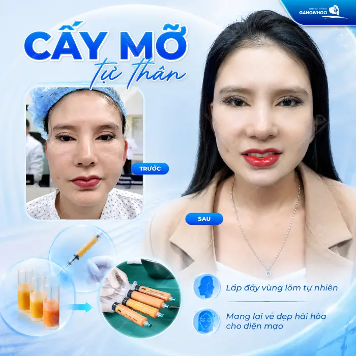 Cấy Mỡ Thái Dương Là Gì? Có An Toàn Không?