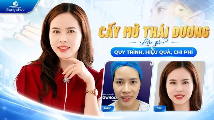 Cấy Mỡ Thái Dương Là Gì? Có An Toàn Không?