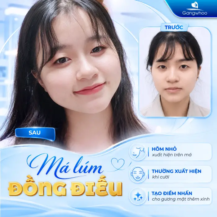 Má Lúm Đồng Điếu Là Gì? Ý Nghĩa Tướng Số Và Cách Sở Hữu Nụ Cười Duyên