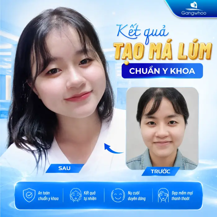 Má Lúm Đồng Điếu Là Gì? Ý Nghĩa Tướng Số Và Cách Sở Hữu Nụ Cười Duyên