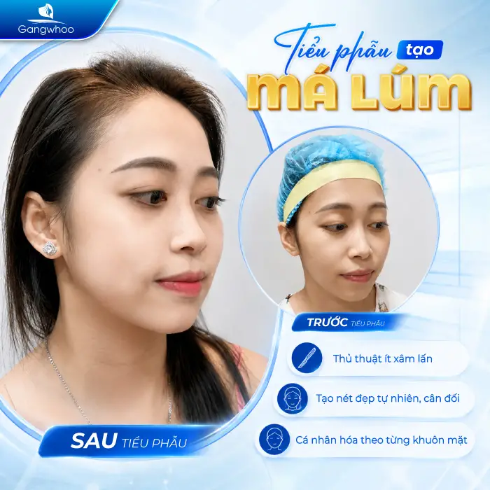 Má Lúm Đồng Điếu Là Gì? Ý Nghĩa Tướng Số Và Cách Sở Hữu Nụ Cười Duyên