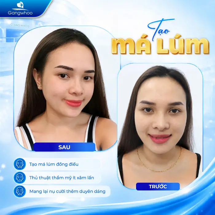 Má Lúm Đồng Điếu Là Gì? Ý Nghĩa Tướng Số Và Cách Sở Hữu Nụ Cười Duyên