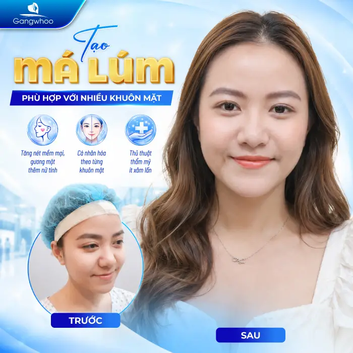 Má Lúm Đồng Điếu Là Gì? Ý Nghĩa Tướng Số Và Cách Sở Hữu Nụ Cười Duyên