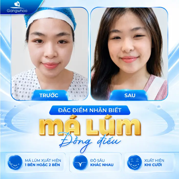 Má Lúm Đồng Điếu Là Gì? Ý Nghĩa Tướng Số Và Cách Sở Hữu Nụ Cười Duyên