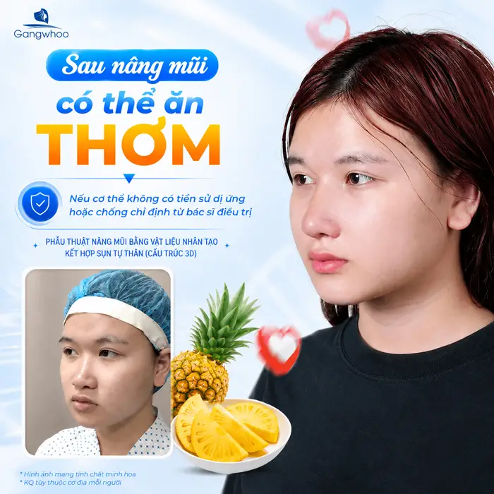 Nâng Mũi Ăn Thơm Được Không? 3 Lưu Ý Quan Trọng Từ Bác Sĩ