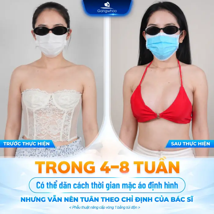 Nâng Ngực Bao Lâu Được Thả Rông? Tác Hại Khi Thả Rông Quá Sớm