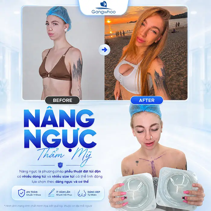 Bơm Ngực Khác Gì Nâng Ngực? Phân Biệt Chi Tiết Chuẩn Y Khoa