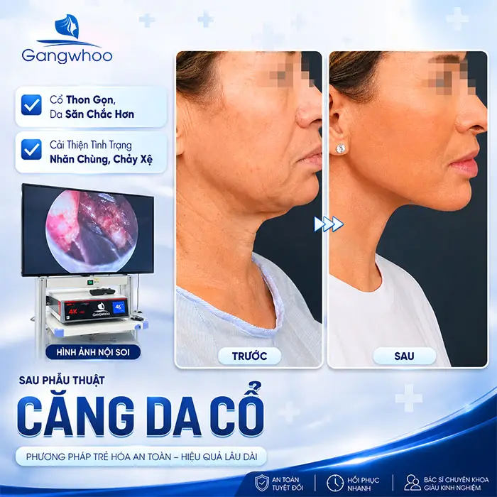 Căng Da Cổ Giá Bao Nhiêu? Bảng Giá Căng Da Cổ Năm 2026