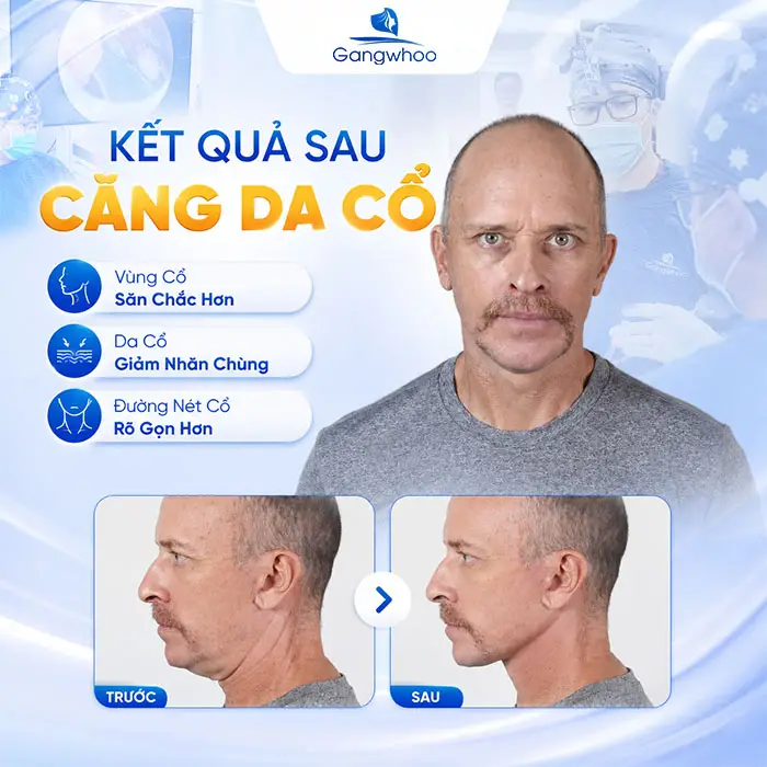 Căng Da Cổ Giá Bao Nhiêu? Bảng Giá Căng Da Cổ Năm 2026