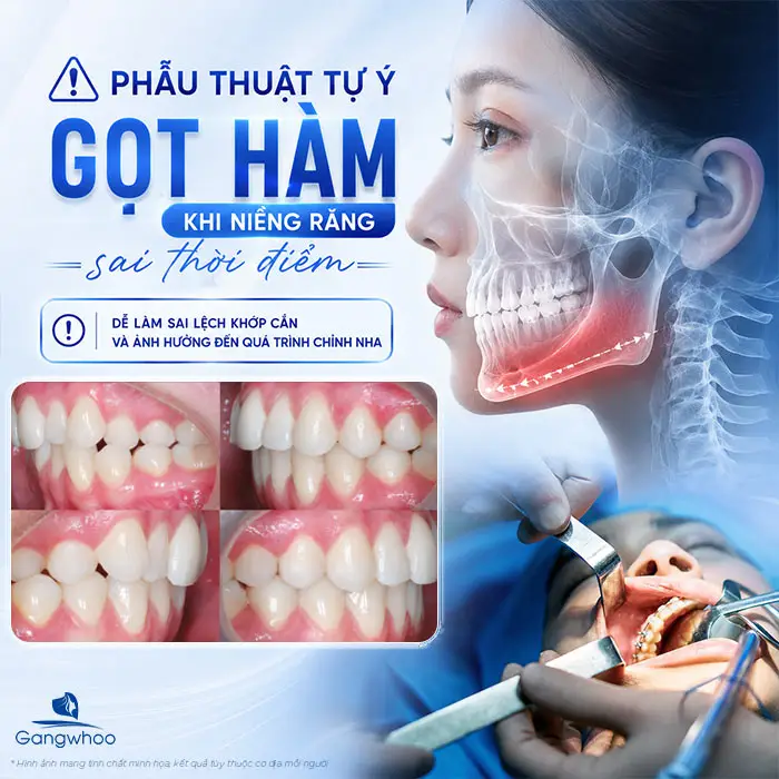 Đang Niềng Răng Có Gọt Hàm Được Không? Lời Khuyên Từ Bác Sĩ