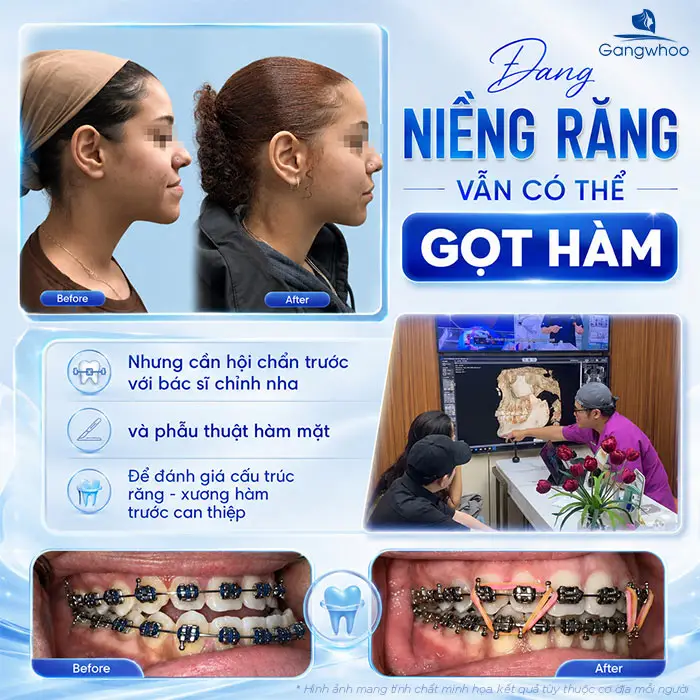 Đang Niềng Răng Có Gọt Hàm Được Không? Lời Khuyên Từ Bác Sĩ
