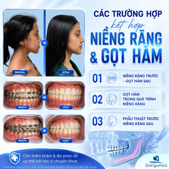 Đang Niềng Răng Có Gọt Hàm Được Không? Lời Khuyên Từ Bác Sĩ