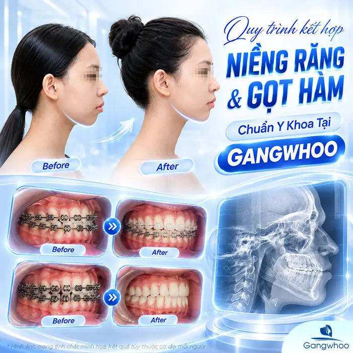 Đang Niềng Răng Có Gọt Hàm Được Không? Lời Khuyên Từ Bác Sĩ