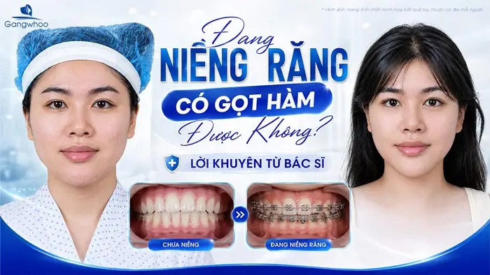 Đang Niềng Răng Có Gọt Hàm Được Không? Lời Khuyên Từ Bác Sĩ