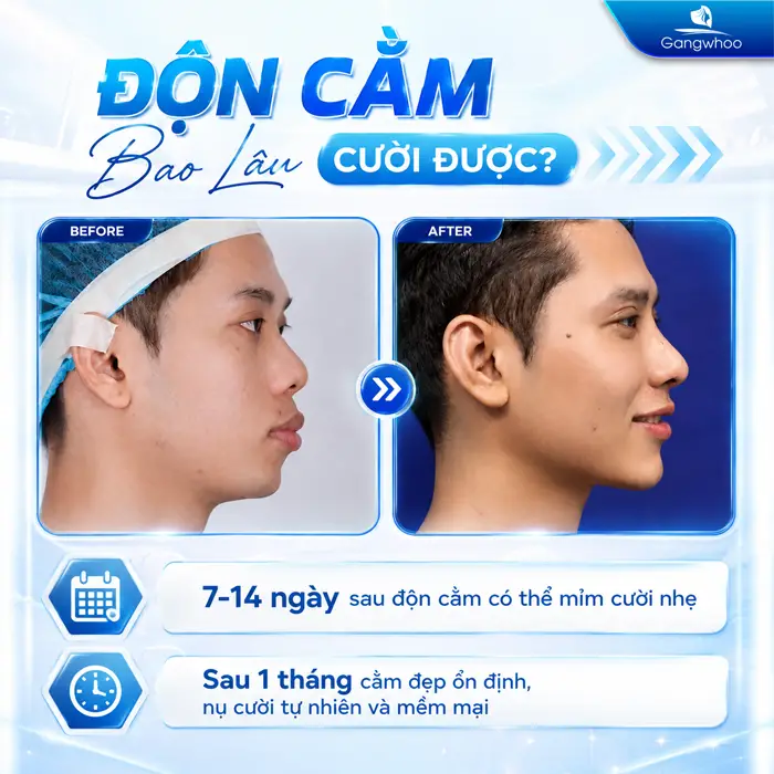 Độn Cằm Bao Lâu Cười Được? Những Yếu Tố Quyết Định