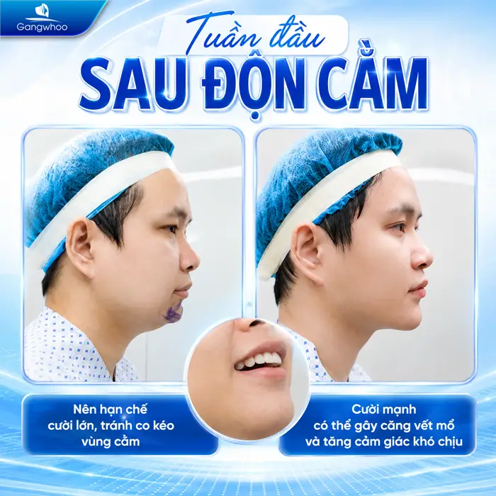 Độn Cằm Bao Lâu Cười Được? Những Yếu Tố Quyết Định